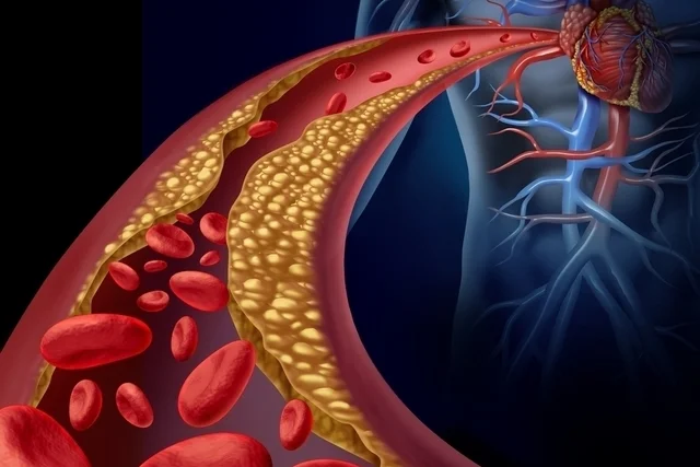 dislipidemia