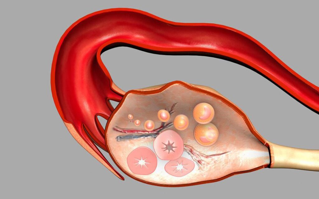 síndrome dos ovários policísticos